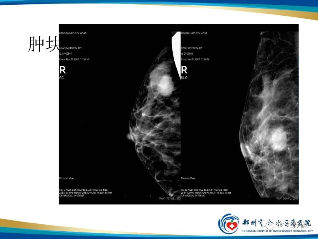 影像PPT - 【PPT】乳腺数字化钼靶X线诊断及临床应用-24