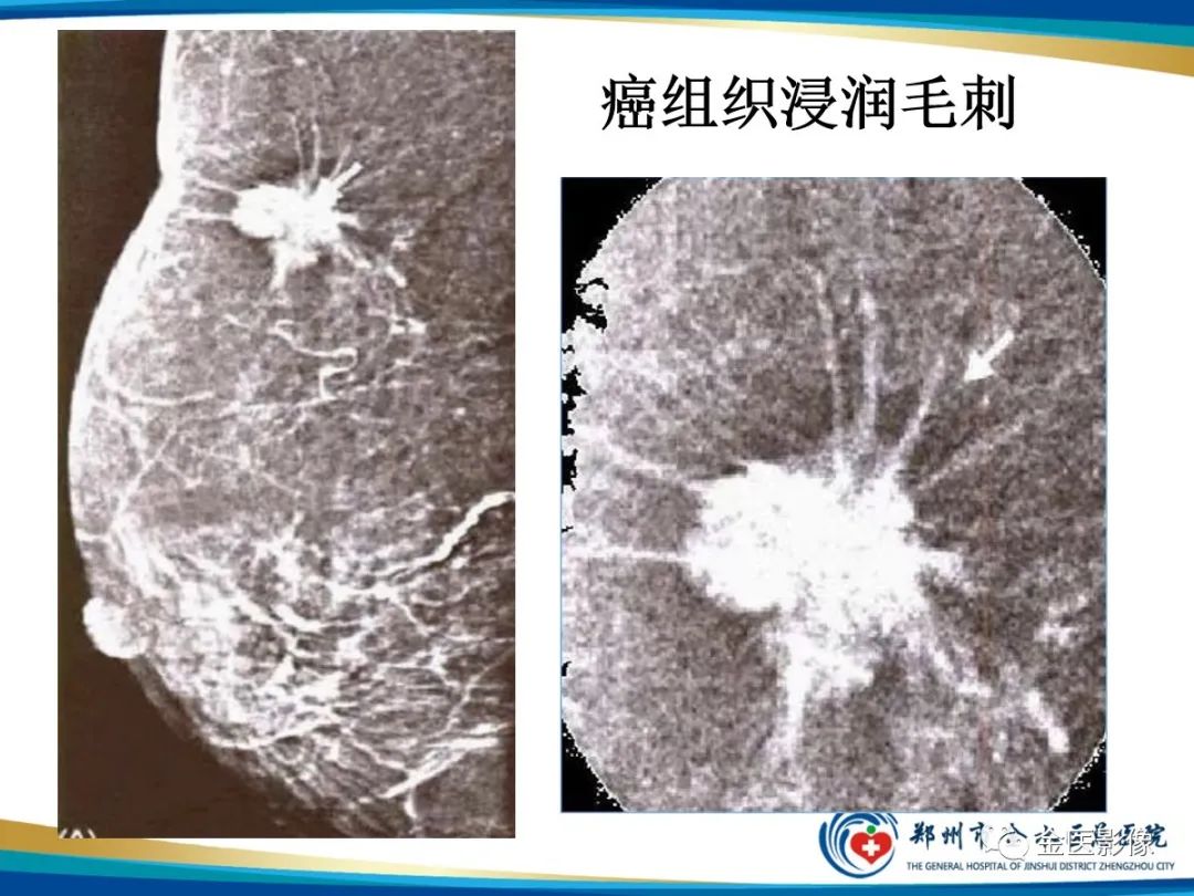 影像PPT - 【PPT】乳腺数字化钼靶X线诊断及临床应用-25