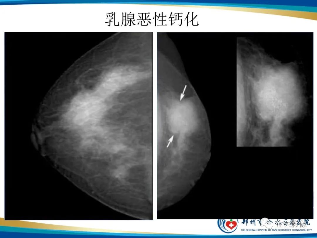 影像PPT - 【PPT】乳腺数字化钼靶X线诊断及临床应用-27