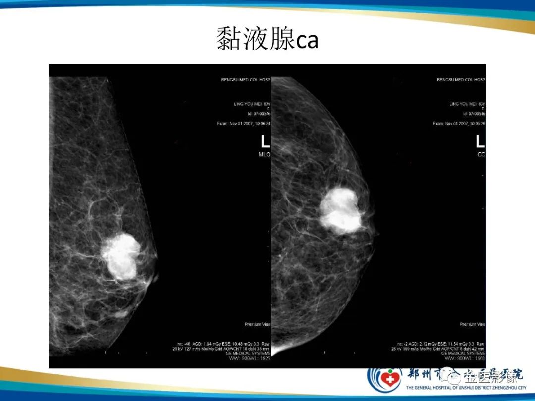 影像PPT - 【PPT】乳腺数字化钼靶X线诊断及临床应用-28