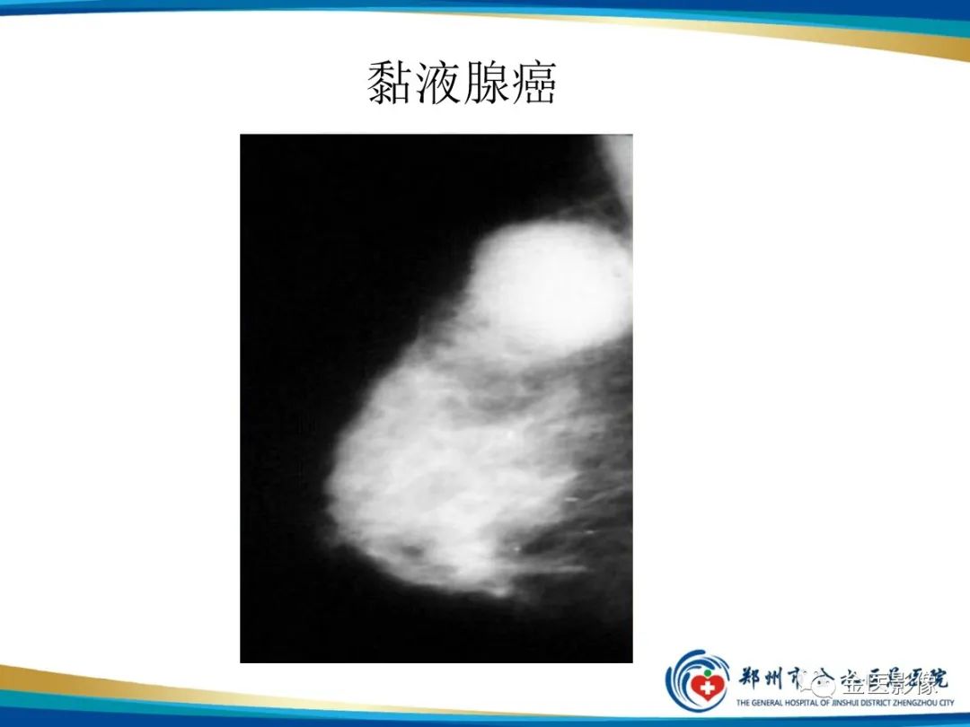 影像PPT - 【PPT】乳腺数字化钼靶X线诊断及临床应用-29