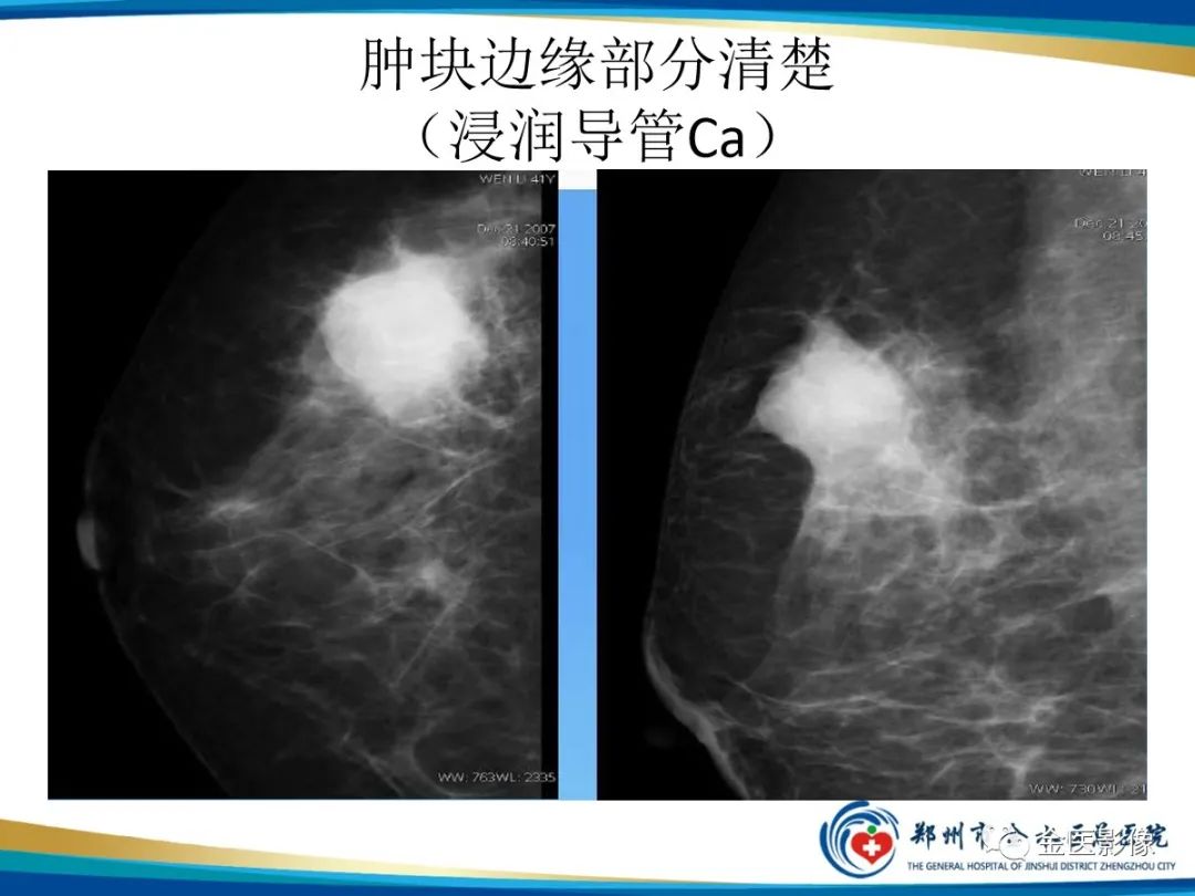 影像PPT - 【PPT】乳腺数字化钼靶X线诊断及临床应用-30