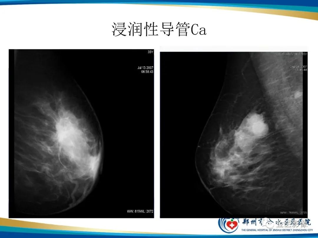 影像PPT - 【PPT】乳腺数字化钼靶X线诊断及临床应用-31
