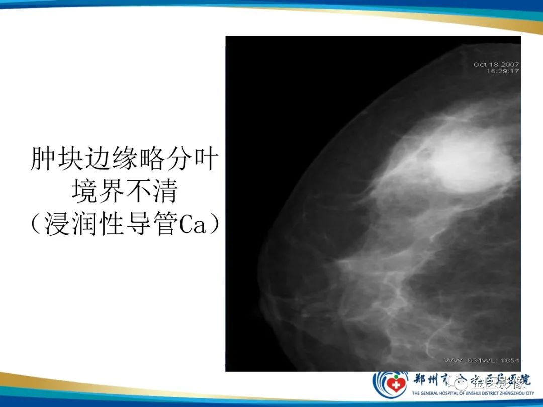 影像PPT - 【PPT】乳腺数字化钼靶X线诊断及临床应用-32