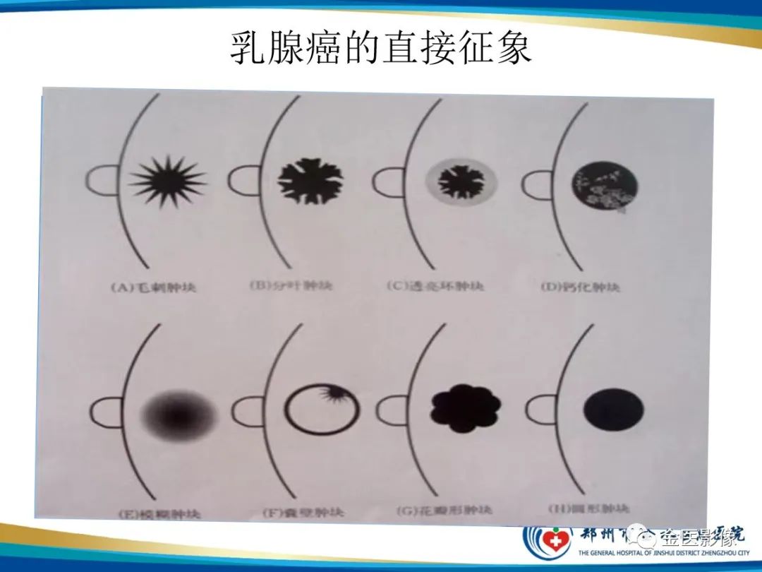 影像PPT - 【PPT】乳腺数字化钼靶X线诊断及临床应用-34