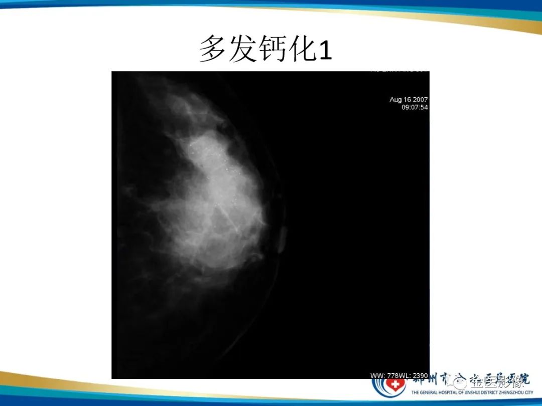影像PPT - 【PPT】乳腺数字化钼靶X线诊断及临床应用-37