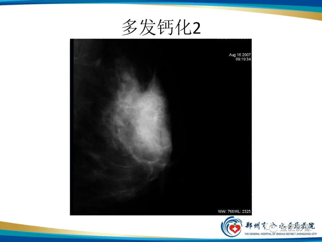 影像PPT - 【PPT】乳腺数字化钼靶X线诊断及临床应用-38