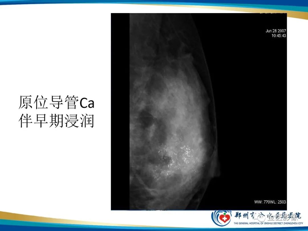 影像PPT - 【PPT】乳腺数字化钼靶X线诊断及临床应用-39