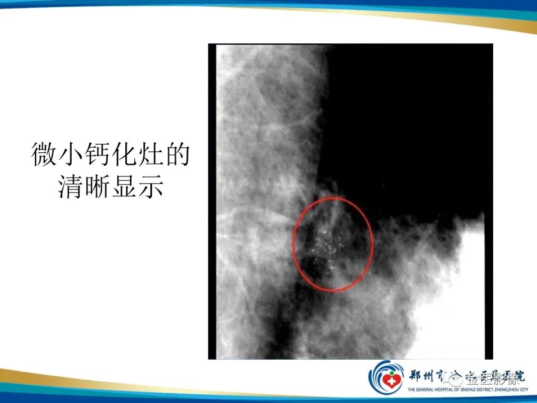 影像PPT - 【PPT】乳腺数字化钼靶X线诊断及临床应用-40
