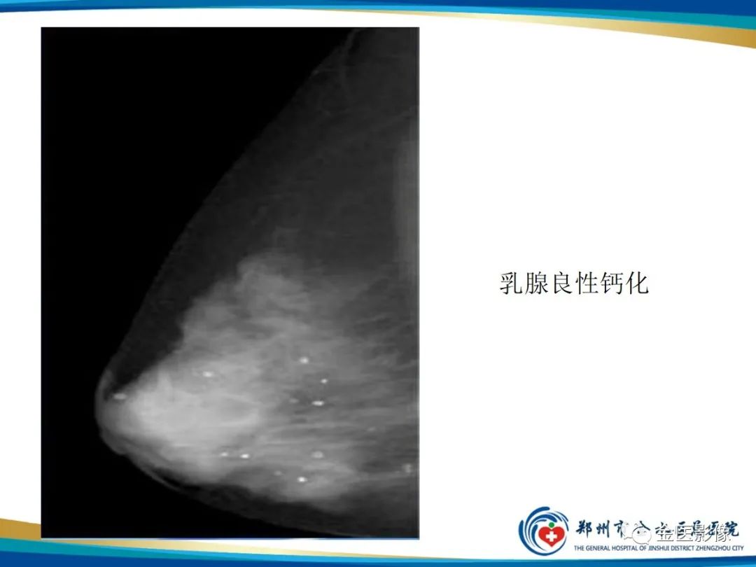 影像PPT - 【PPT】乳腺数字化钼靶X线诊断及临床应用-42