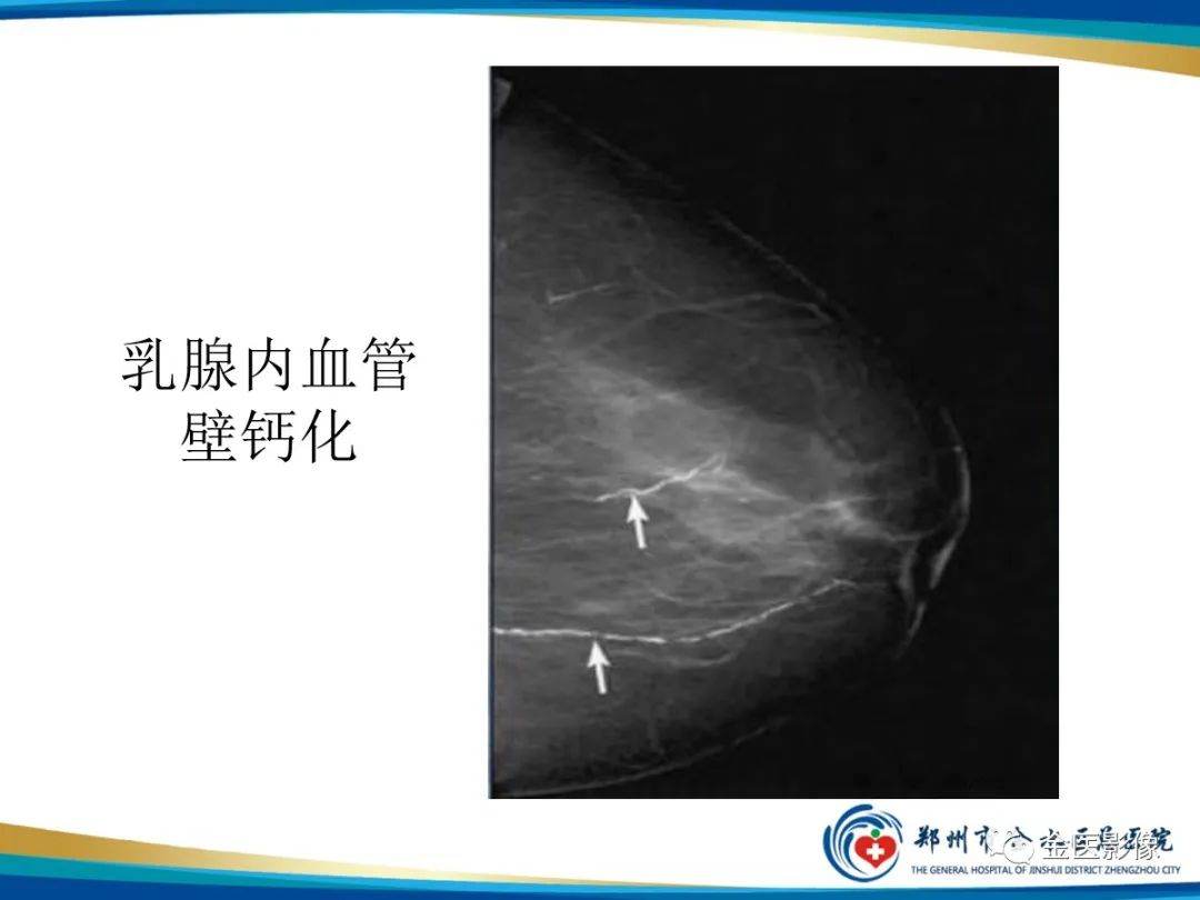 影像PPT - 【PPT】乳腺数字化钼靶X线诊断及临床应用-43
