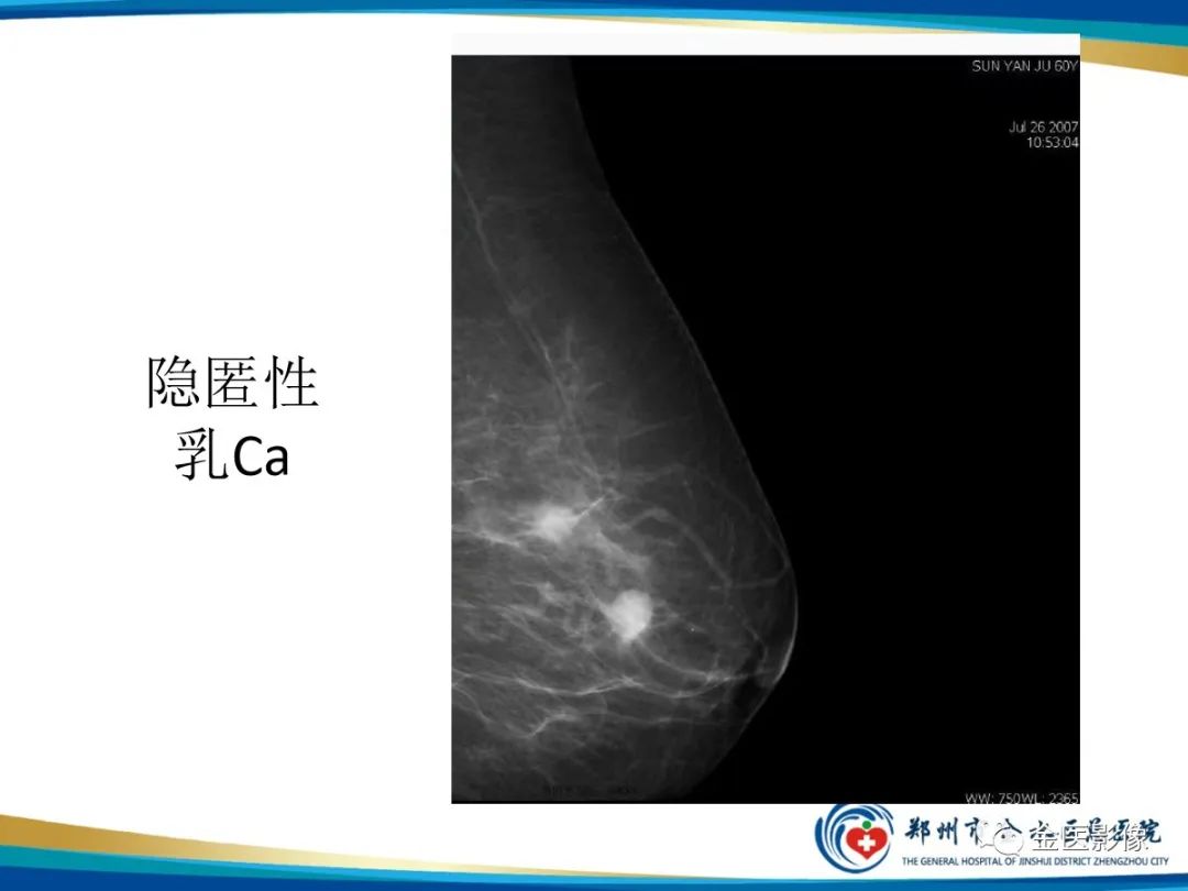 影像PPT - 【PPT】乳腺数字化钼靶X线诊断及临床应用-44