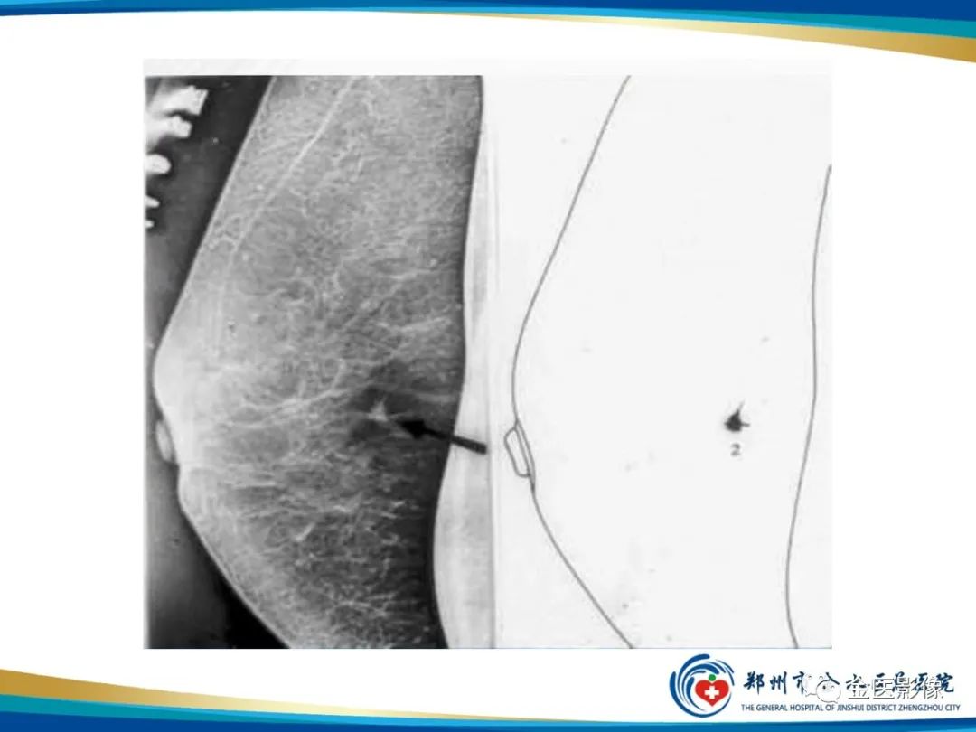 影像PPT - 【PPT】乳腺数字化钼靶X线诊断及临床应用-45