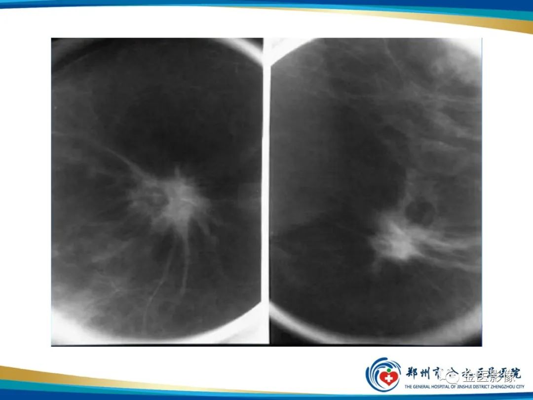 影像PPT - 【PPT】乳腺数字化钼靶X线诊断及临床应用-46