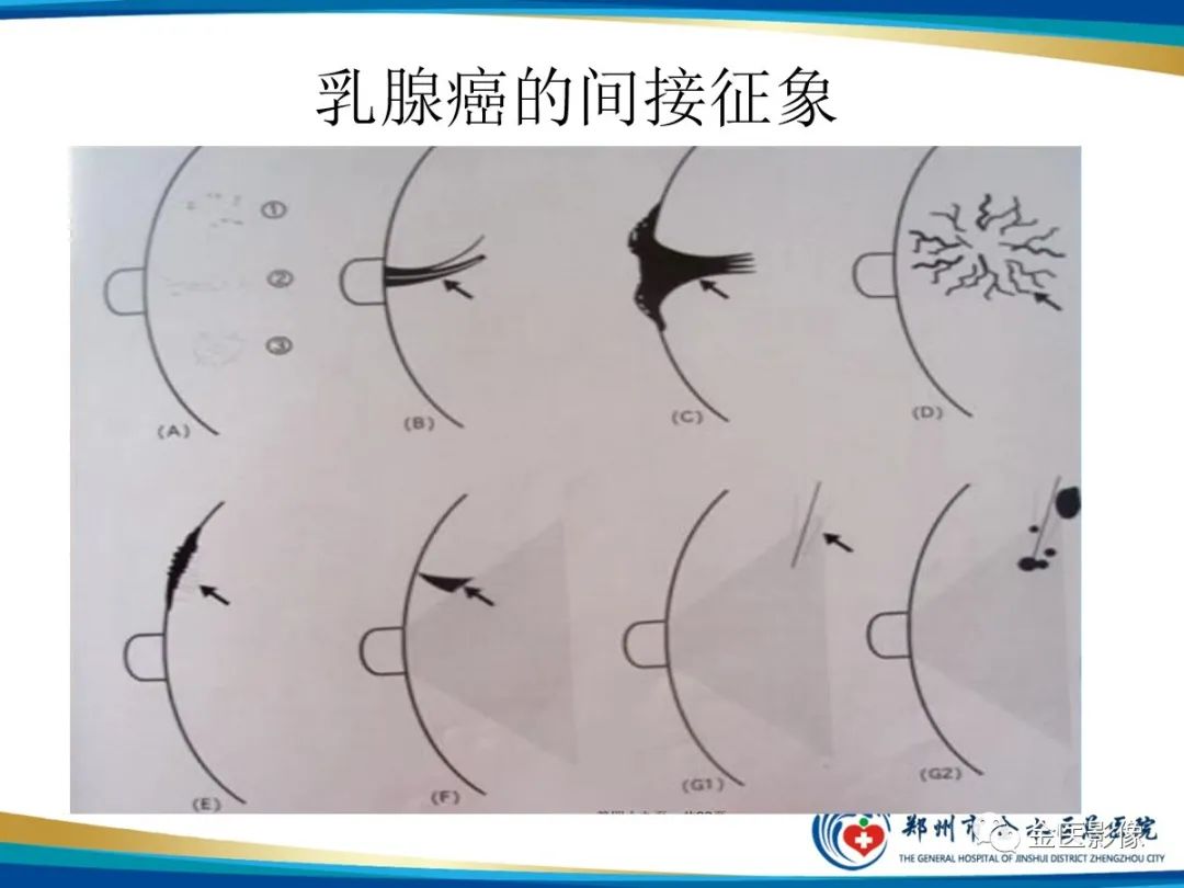 影像PPT - 【PPT】乳腺数字化钼靶X线诊断及临床应用-48