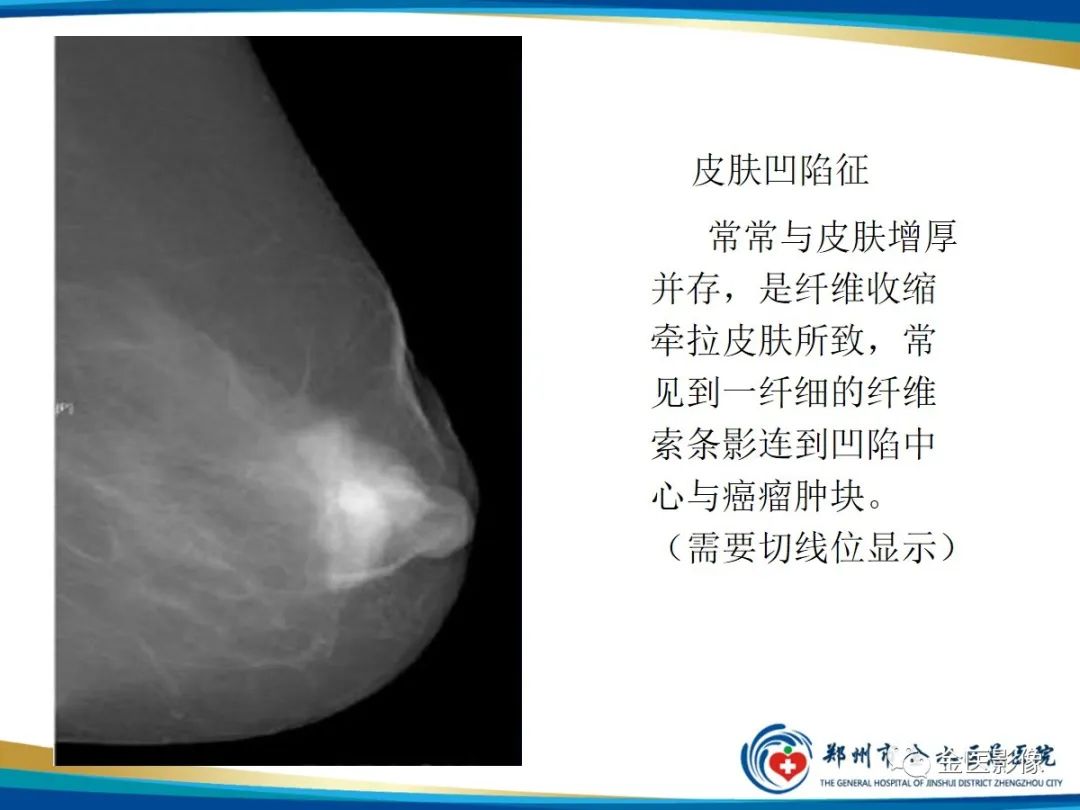 影像PPT - 【PPT】乳腺数字化钼靶X线诊断及临床应用-49