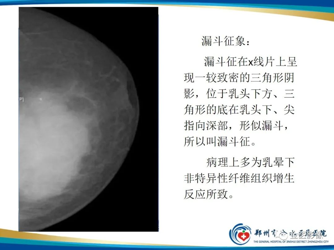 影像PPT - 【PPT】乳腺数字化钼靶X线诊断及临床应用-50