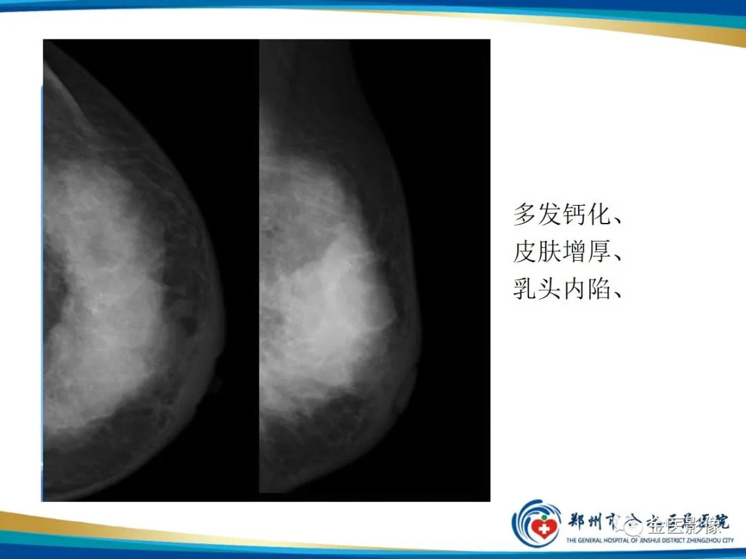 影像PPT - 【PPT】乳腺数字化钼靶X线诊断及临床应用-51