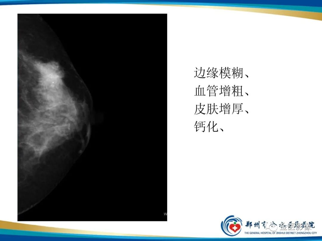 影像PPT - 【PPT】乳腺数字化钼靶X线诊断及临床应用-52