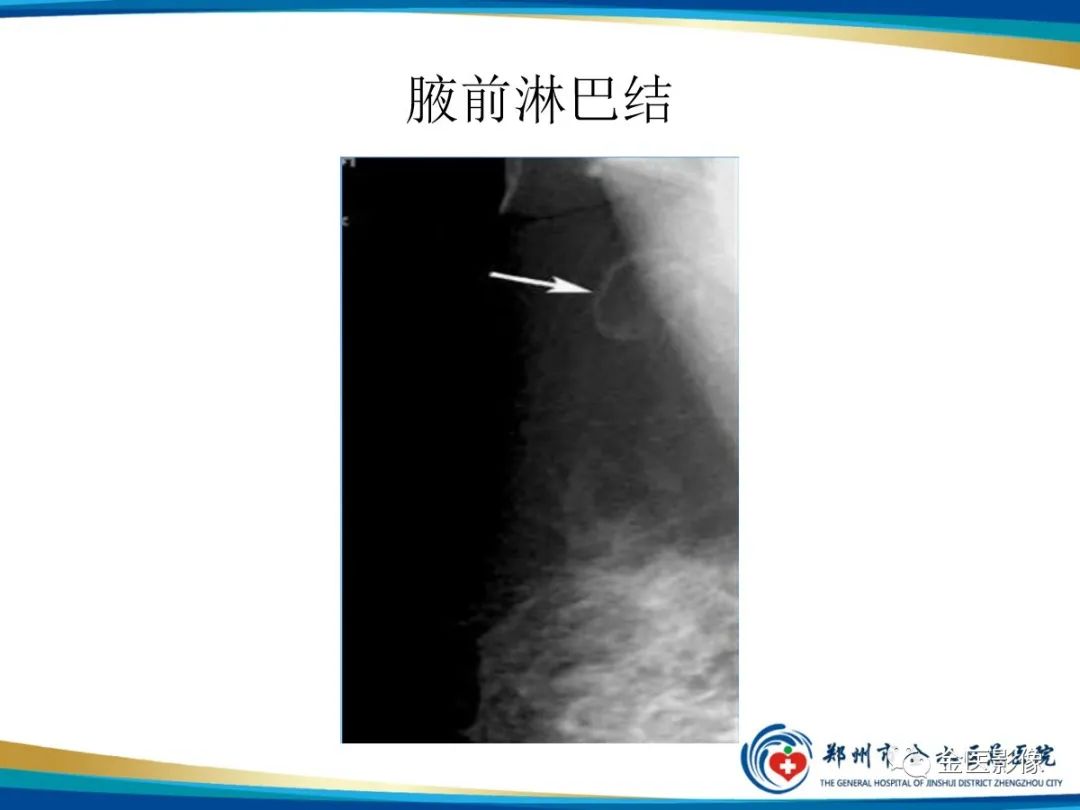 影像PPT - 【PPT】乳腺数字化钼靶X线诊断及临床应用-54