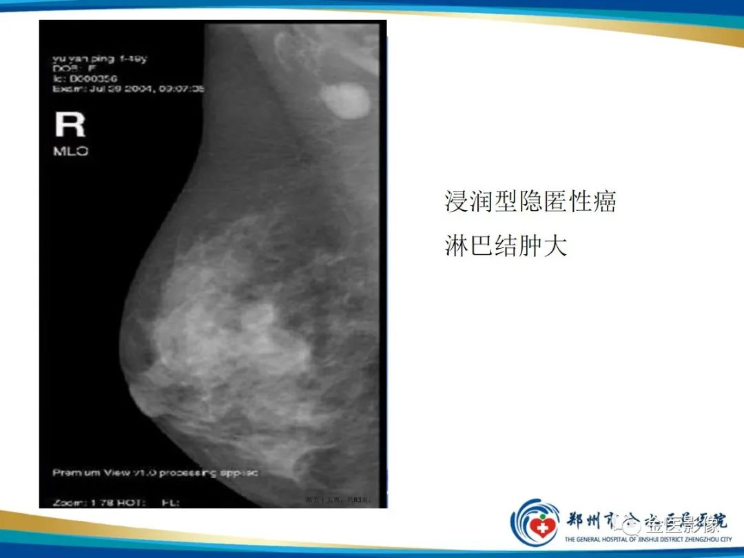 影像PPT - 【PPT】乳腺数字化钼靶X线诊断及临床应用-53