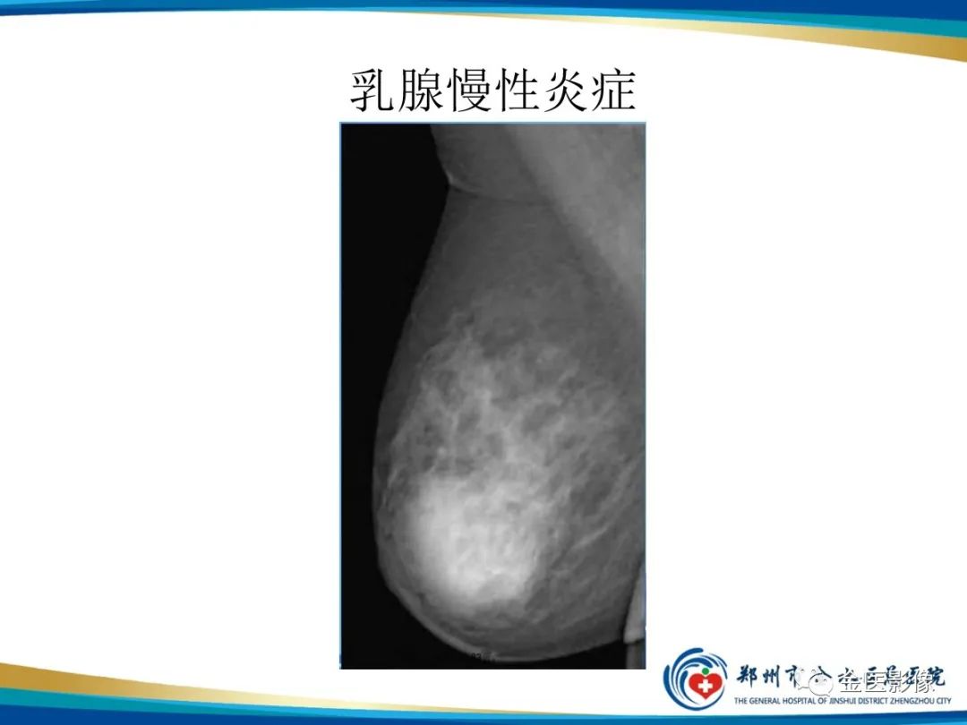 影像PPT - 【PPT】乳腺数字化钼靶X线诊断及临床应用-56