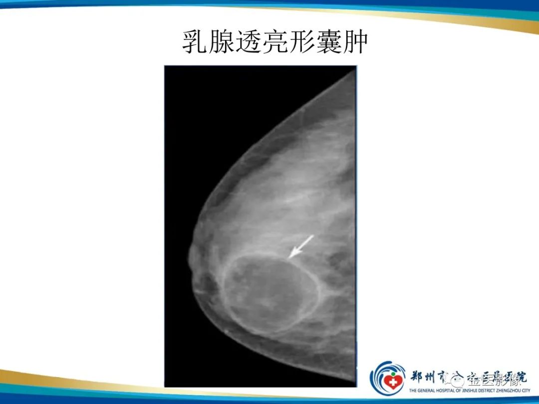 影像PPT - 【PPT】乳腺数字化钼靶X线诊断及临床应用-57