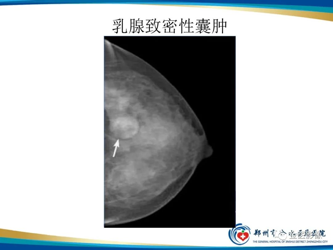 影像PPT - 【PPT】乳腺数字化钼靶X线诊断及临床应用-58