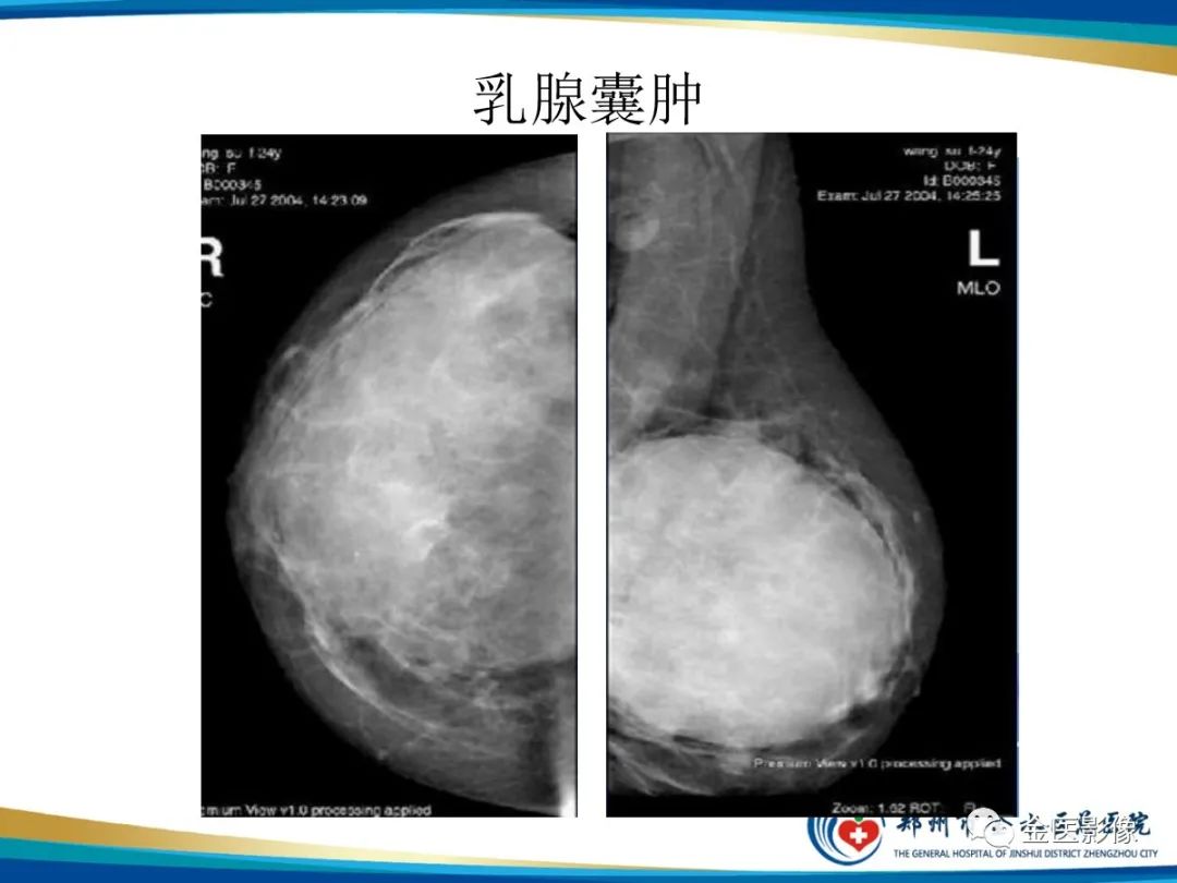 影像PPT - 【PPT】乳腺数字化钼靶X线诊断及临床应用-59