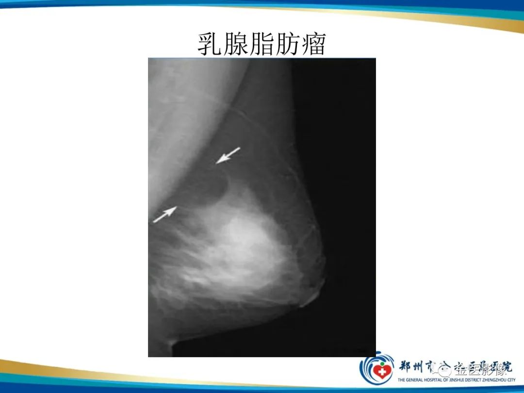 影像PPT - 【PPT】乳腺数字化钼靶X线诊断及临床应用-60