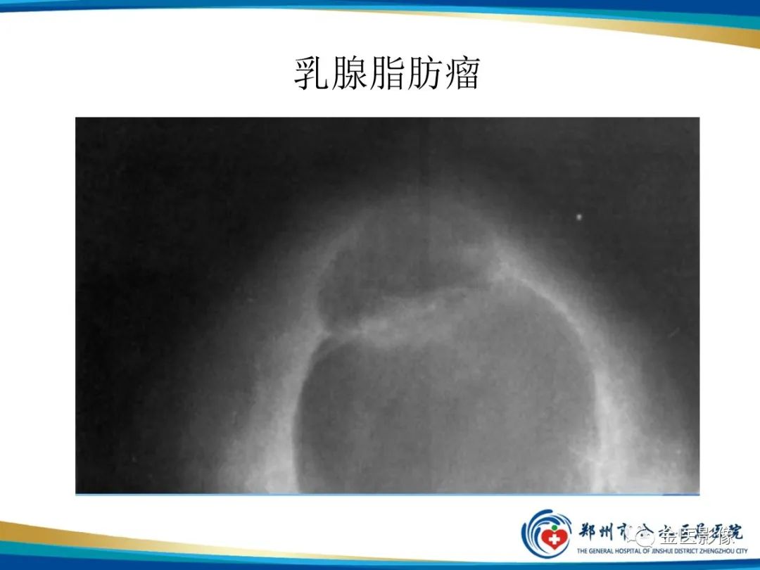 影像PPT - 【PPT】乳腺数字化钼靶X线诊断及临床应用-61