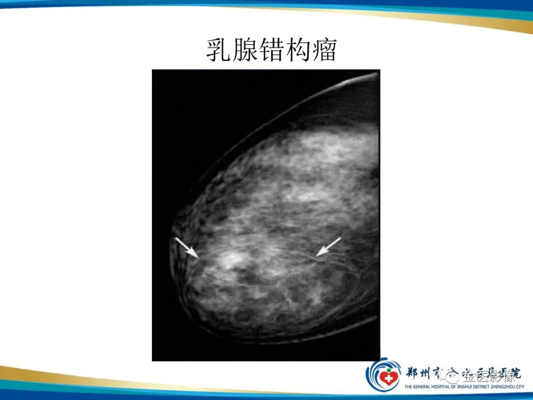 影像PPT - 【PPT】乳腺数字化钼靶X线诊断及临床应用-62