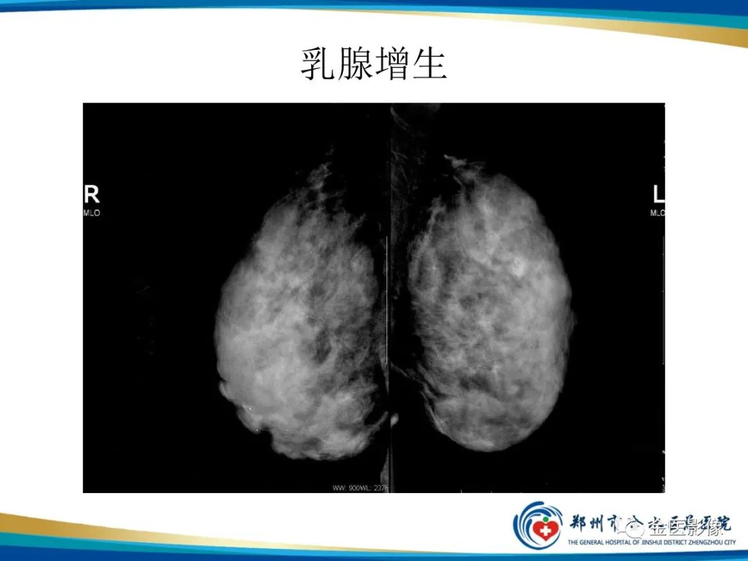 影像PPT - 【PPT】乳腺数字化钼靶X线诊断及临床应用-63