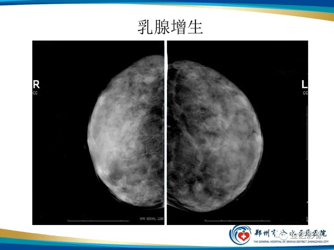 影像PPT - 【PPT】乳腺数字化钼靶X线诊断及临床应用-64