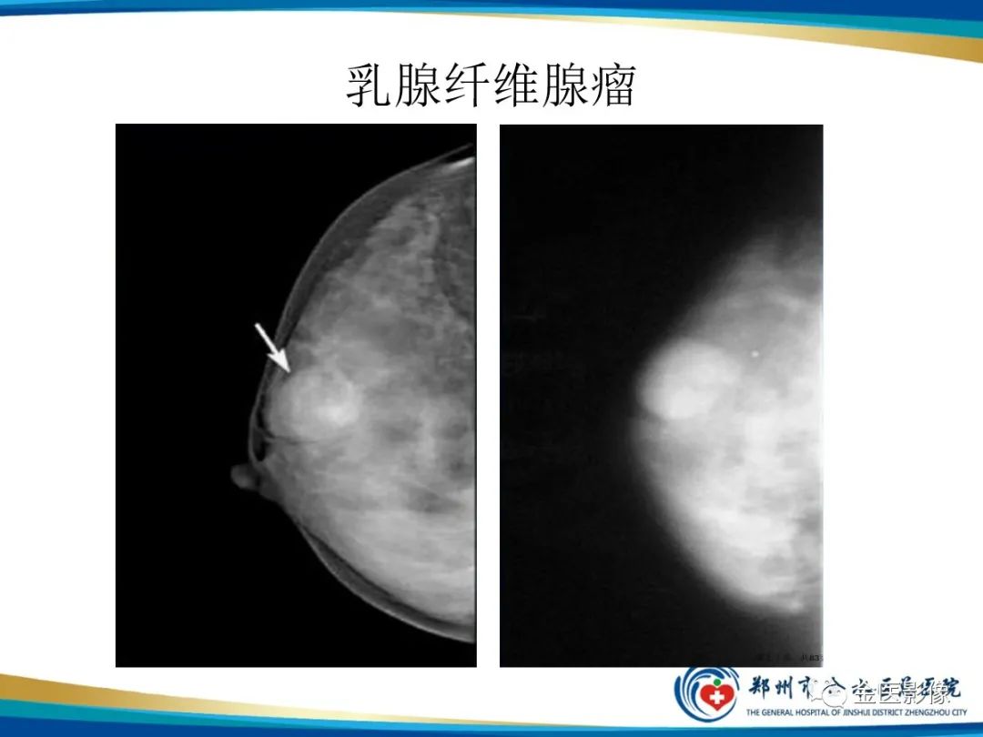影像PPT - 【PPT】乳腺数字化钼靶X线诊断及临床应用-65