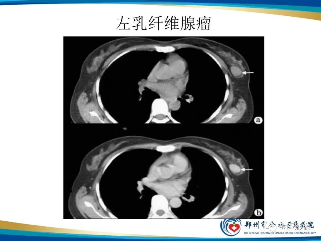 影像PPT - 【PPT】乳腺数字化钼靶X线诊断及临床应用-66