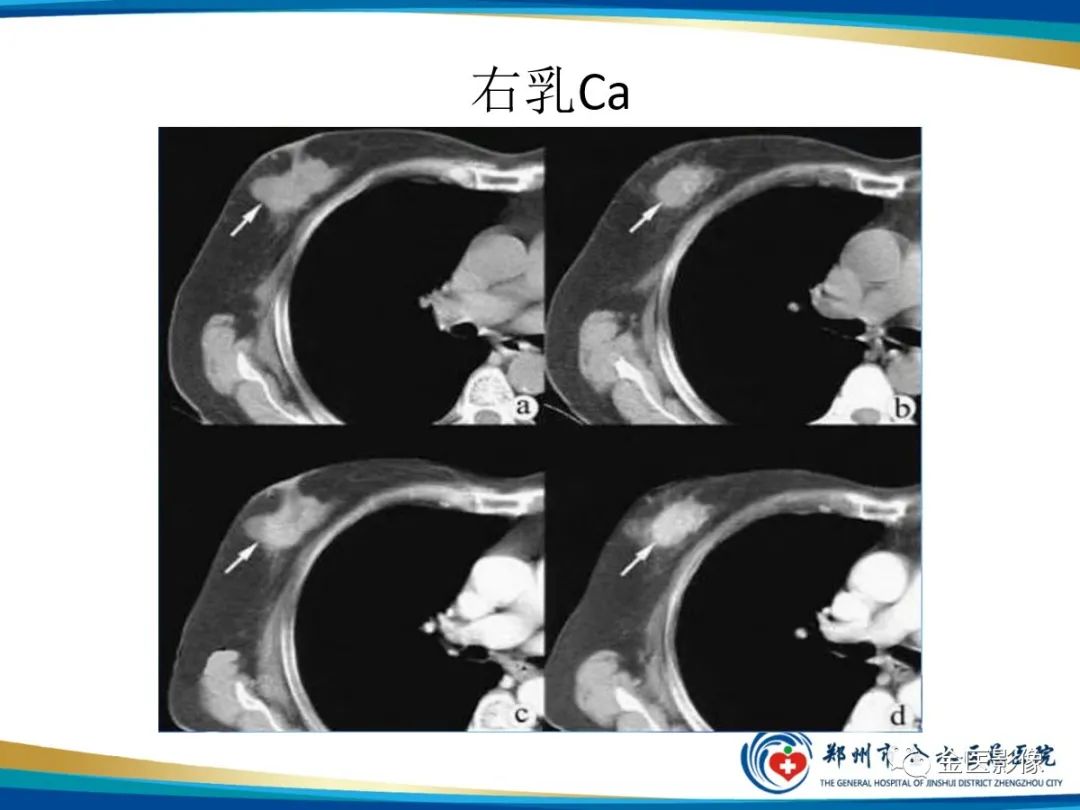 影像PPT - 【PPT】乳腺数字化钼靶X线诊断及临床应用-67