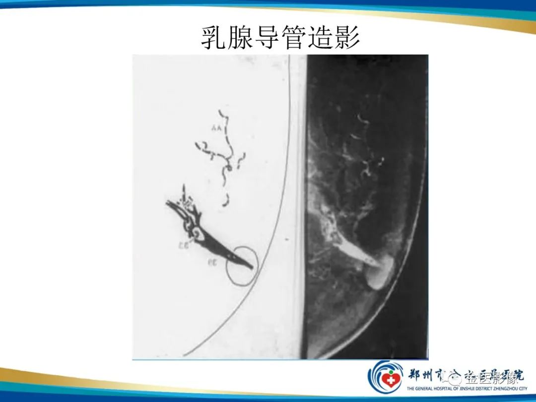 影像PPT - 【PPT】乳腺数字化钼靶X线诊断及临床应用-70