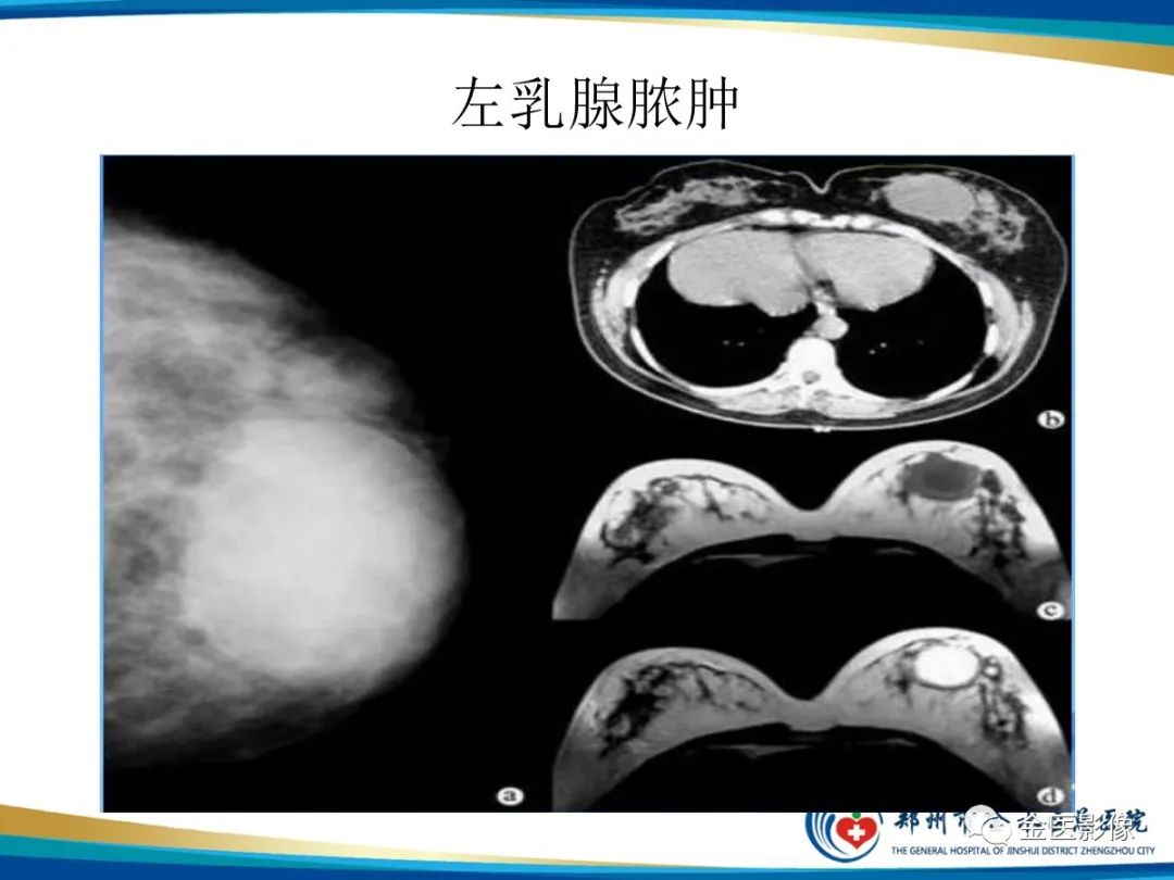 影像PPT - 【PPT】乳腺数字化钼靶X线诊断及临床应用-68