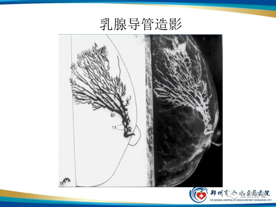 影像PPT - 【PPT】乳腺数字化钼靶X线诊断及临床应用-69