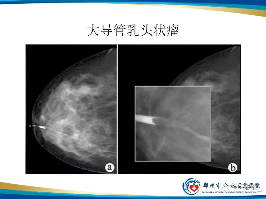 影像PPT - 【PPT】乳腺数字化钼靶X线诊断及临床应用-71