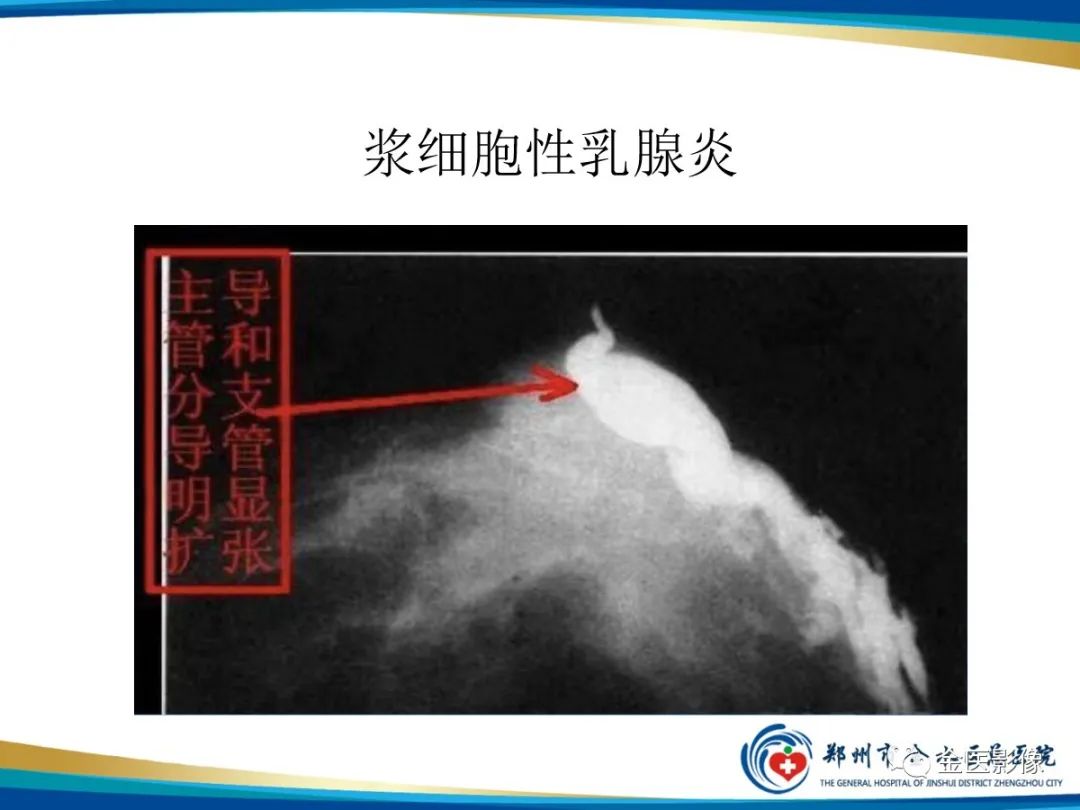影像PPT - 【PPT】乳腺数字化钼靶X线诊断及临床应用-72