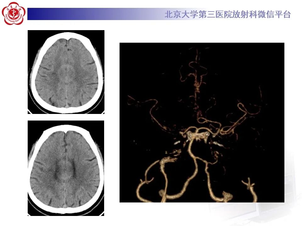 影像PPT - 【PPT】烟雾病-3