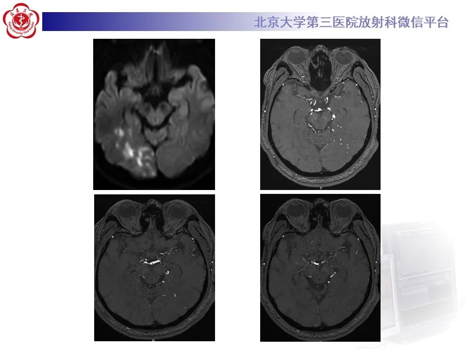 影像PPT - 【PPT】烟雾病-4