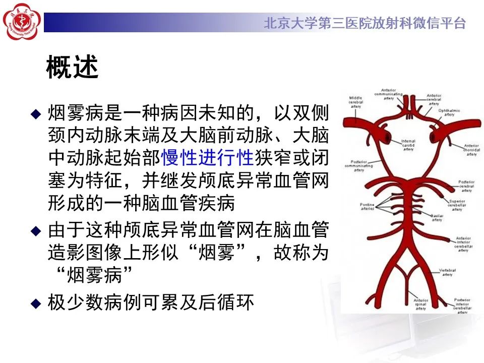 影像PPT - 【PPT】烟雾病-7