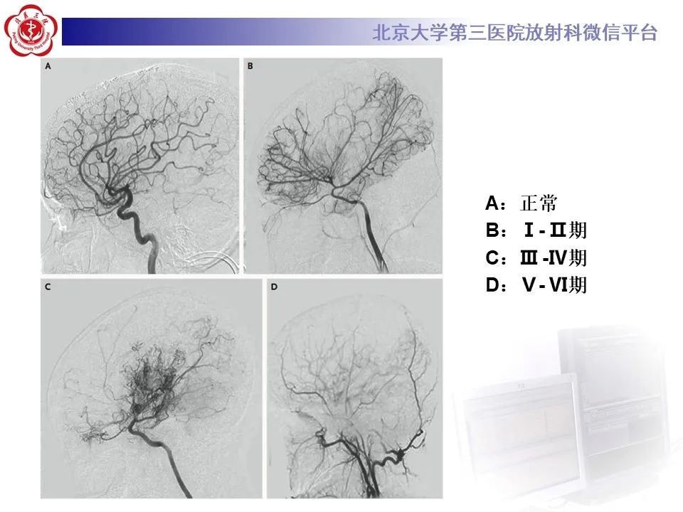 影像PPT - 【PPT】烟雾病-16