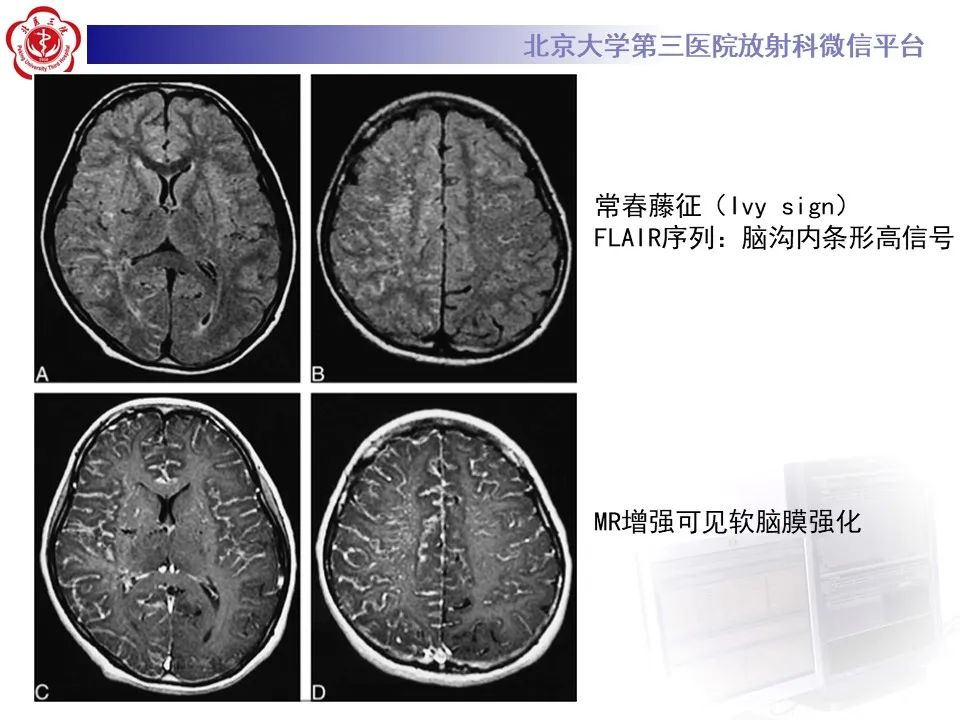 影像PPT - 【PPT】烟雾病-19