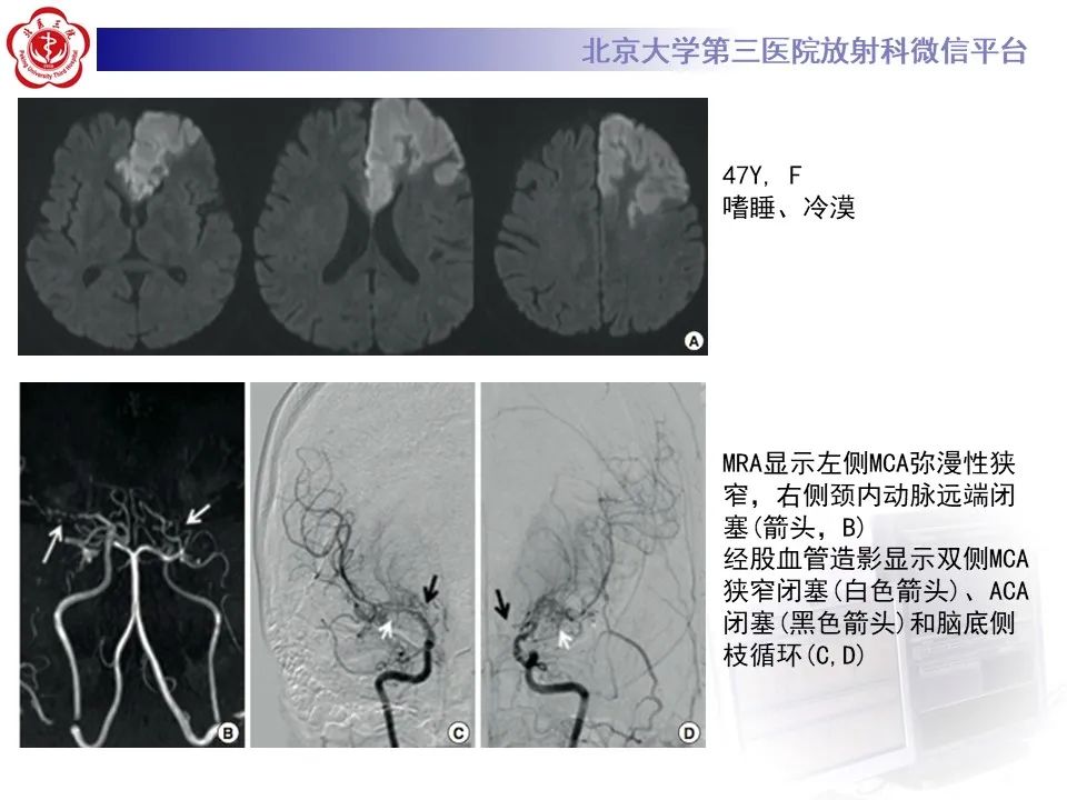 影像PPT - 【PPT】烟雾病-20