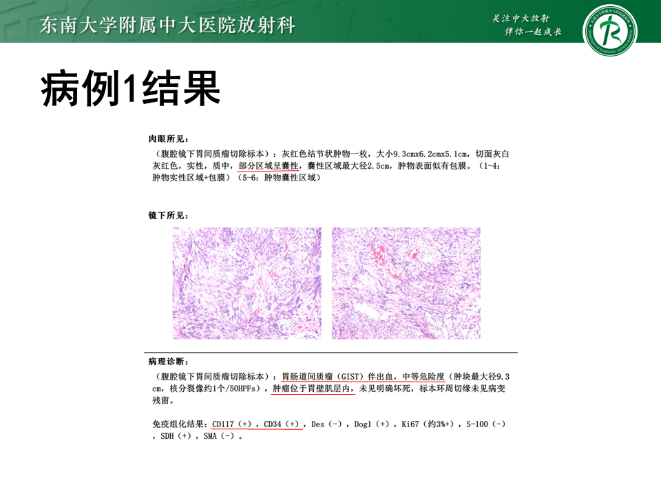 影像PPT - 【PPT】胃间质瘤（GST）-5