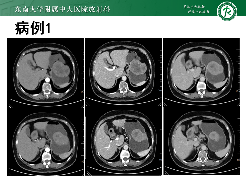 影像PPT - 【PPT】胃间质瘤（GST）-3